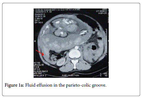 gynecology-obstetrics-parieto-colic-groove