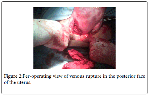 gynecology-obstetrics-venous-rupture