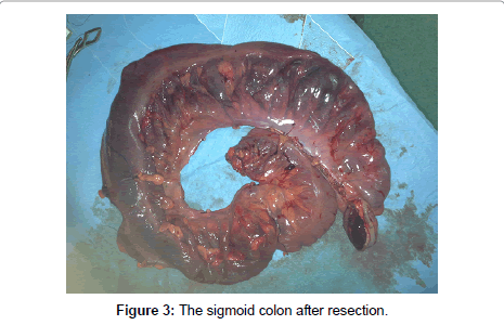 gynecology-sigmoid-colon