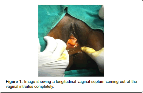 gynecology-vaginal-septum