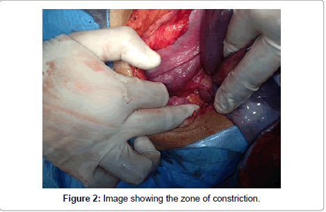 gynecology-zone-constriction