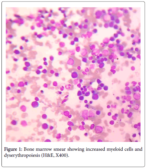 haematology-thromboembolic-Bone-marrow-smear