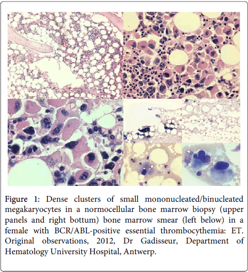 haematology-thromboembolic-Dense-clusters