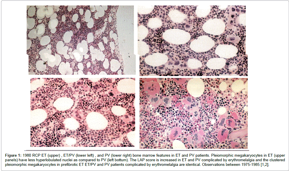 haematology-thromboembolic-diseases-hyperlobulated-nuclei