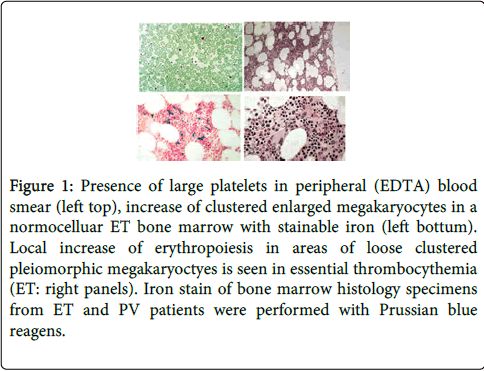 haematology-thromboembolic-diseases-large-platelets