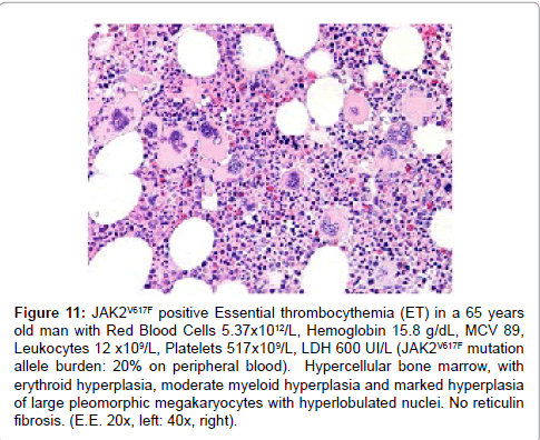haematology-thromboembolic-diseases-marked-hyperplasia