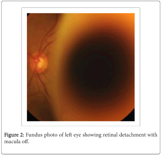 immunological-disorders-immunotherapy-Fundus-photo
