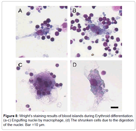 leukemia-Engulfing-nuclei-macrophage