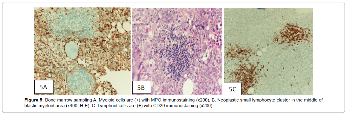 leukemia-bone-MPO-immunostaining