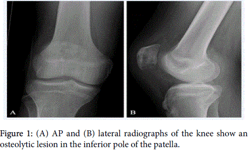 leukemia-lateral-radiographs-knee