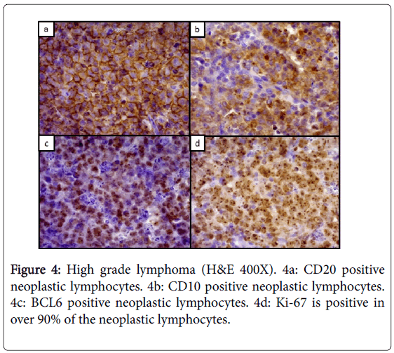 leukemia-neoplastic-lymphocytes