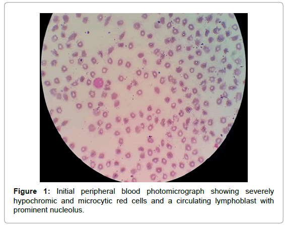 leukemia-peripheral-blood-photomicrograph