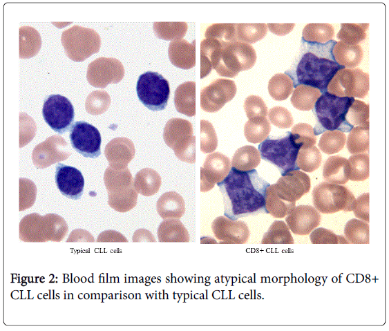 leukemia-typical-CLL-cells