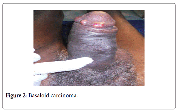 medical-surgical-urology-Basaloid-carcinoma