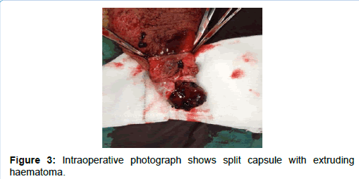 medical-surgical-urology-Intraoperative-split-capsule