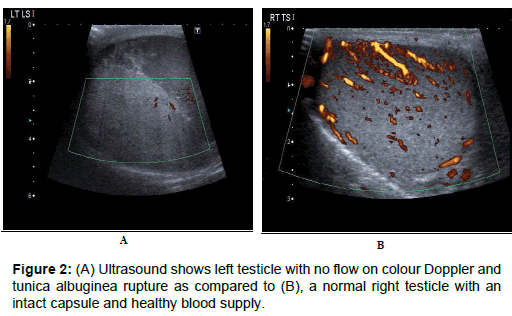 medical-surgical-urology-Ultrasound-left-testicle
