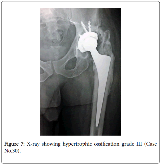 orthopedic-muscular-system-X-ray-showing-hypertrophic-ossification