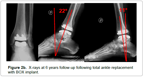 orthopedic-muscular-system-ankle-replacement-implant