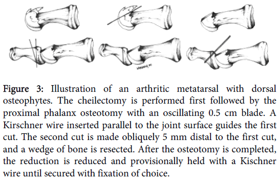 orthopedic-muscular-system-arthritic-metatarsal-dorsal