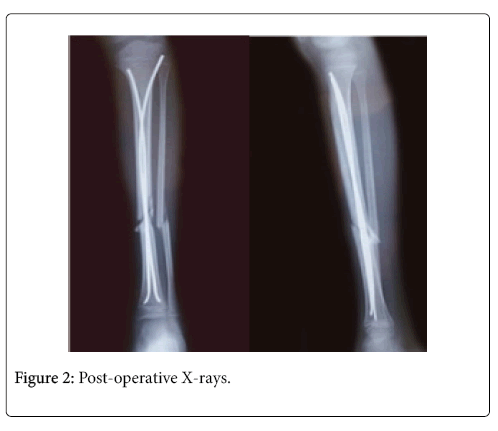 Semiextended Intramedullary Nailing of the Tibia Using a Suprapatellar  Approach: Radiographic Results and Clinical Outcomes at a