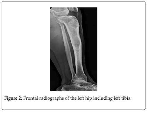 orthopedic-muscular-system-current-research-tibia
