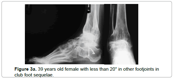 orthopedic-muscular-system-female-footjoints-sequelae