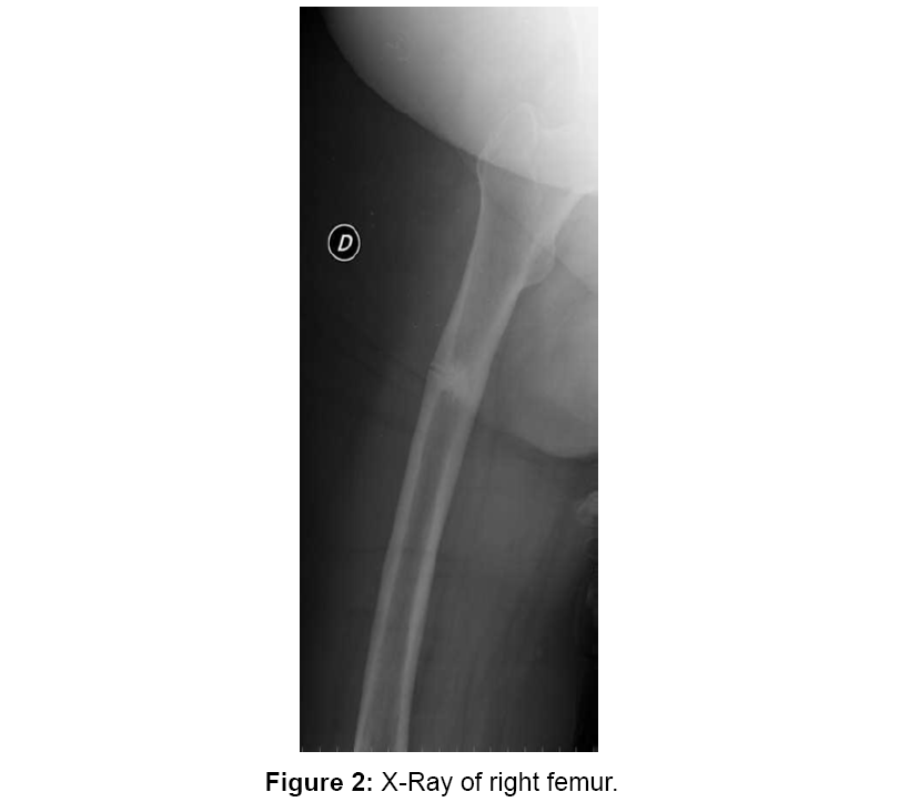 orthopedic-muscular-system-femur