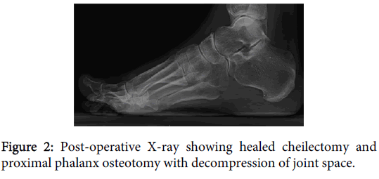 orthopedic-muscular-system-healed-cheilectomy-phalanx