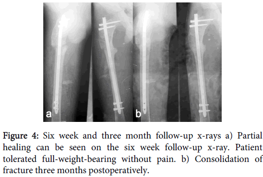 Cureus | Kuntscher Nail: A Forgotten Entity Yet a Reliable Modality in  Treatment of Winquist Type I and II Closed Femoral Shaft Fractures | Article