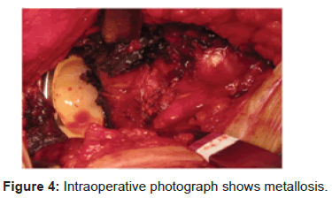 orthopedic-muscular-system-intraoperative-photograph-metallosis