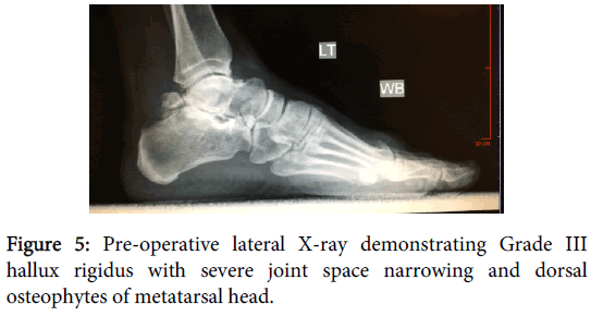 orthopedic-muscular-system-lateral-narrowing-osteophytes