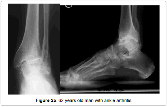 orthopedic-muscular-system-man-ankle-arthritis