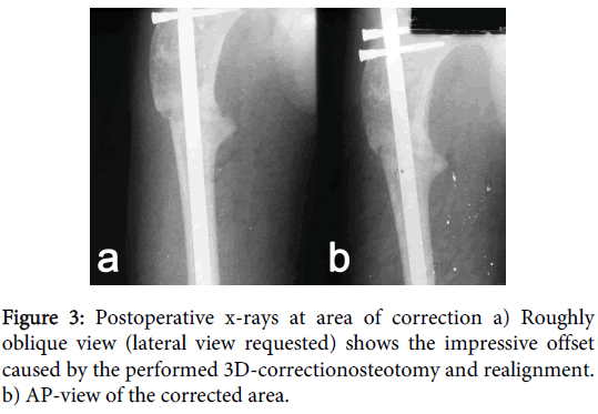 orthopedic-muscular-system-oblique-impressive-correctionosteotomy