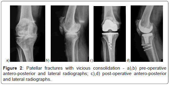 orthopedic-muscular-system-patellar-fractures-vicious