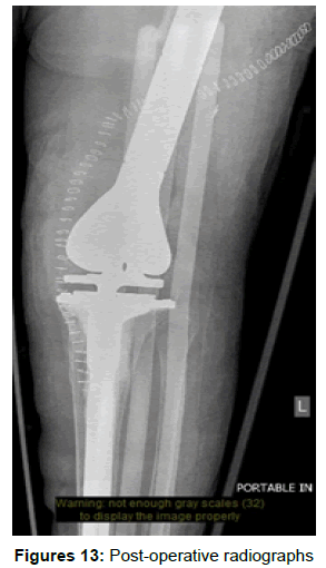 orthopedic-muscular-system-post-operative-radiographs