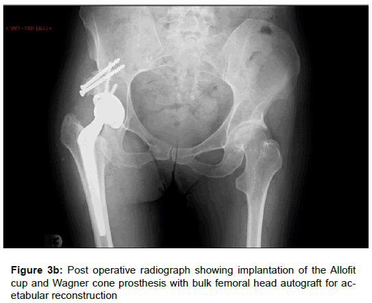orthopedic-muscular-system-radiograph-implantation-prosthesis