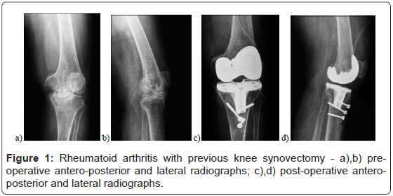 orthopedic-muscular-system-rheumatoid-arthritis-knee
