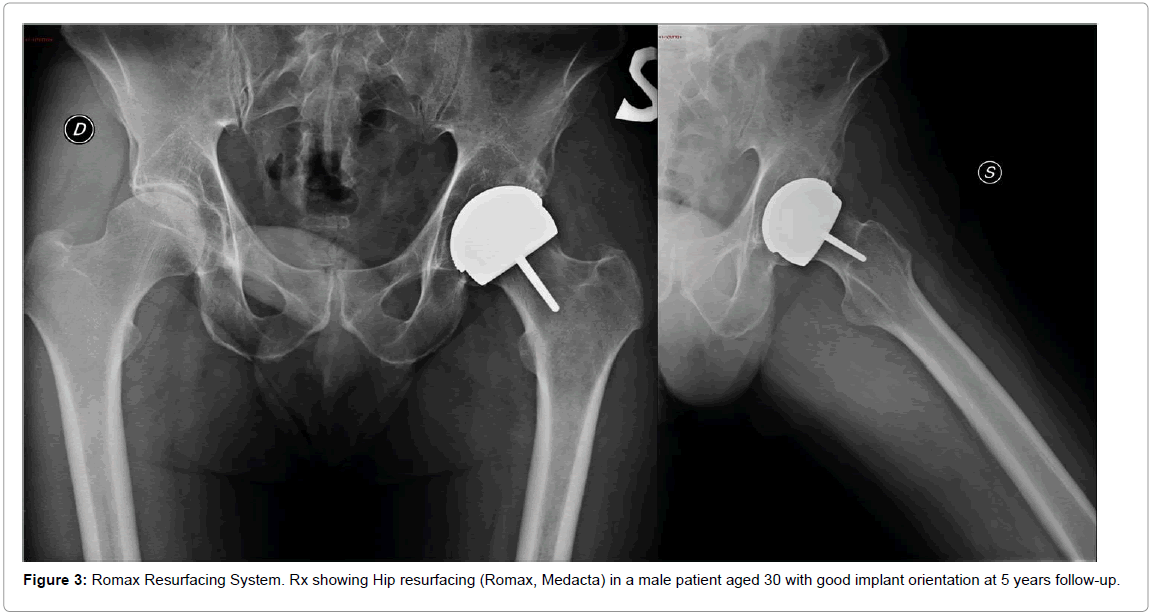orthopedic-muscular-system-romax-resurfacing-hip