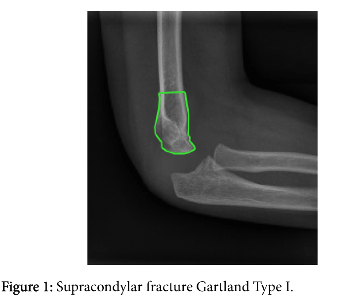Supracondylar Fractures Of The Humerus In Children Review Of Man