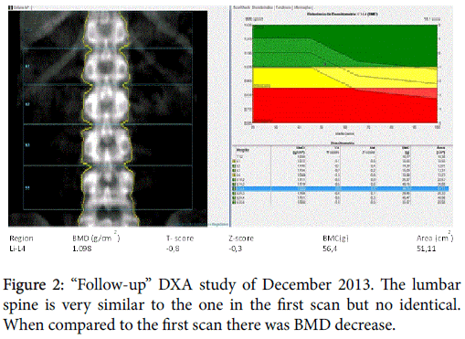 osteoporosis-and-physical-activity-compared-first-scan