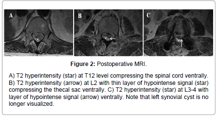 osteoporosis-physical-activity-Postoperative-MRI