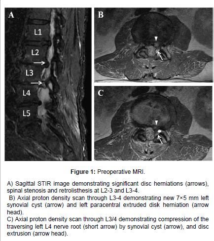 osteoporosis-physical-activity-Preoperative-MRI