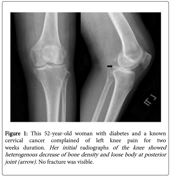 osteoporosis-physical-left-knee-pain