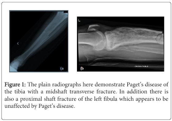 osteoporosis-physical-plain-radiographs