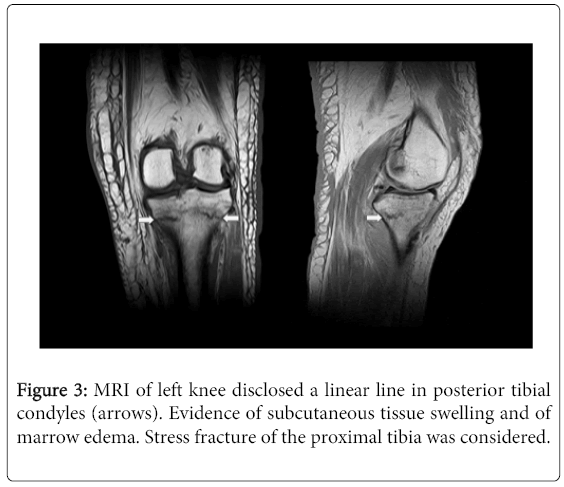 osteoporosis-physical-posterior-tibial