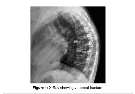 osteoporosis-physical-vertebral-fracture