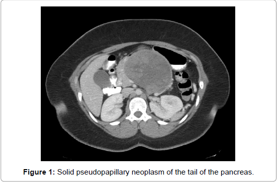 pancreatic-disorders-therapy-Solid-pseudopapillary