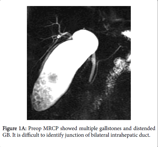 pancreatic-disorders-therapy-multiple-gallstones