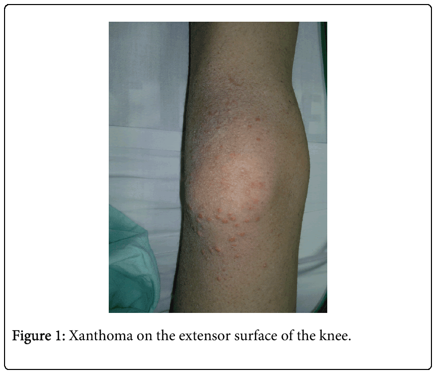 pediatrics-therapeutics-Xanthoma