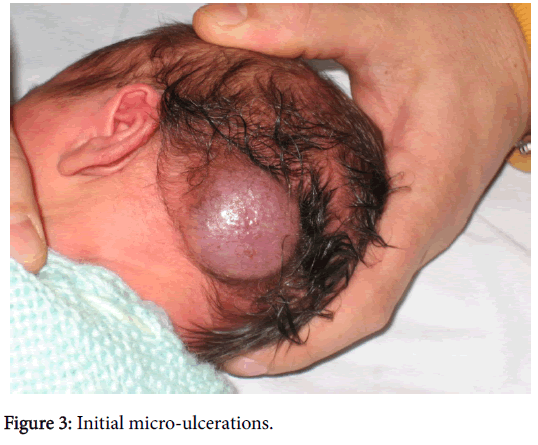 pediatrics-therapeutics-initial-micro-ulcerations